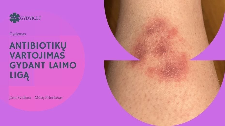Antibiotikų vartojimas gydant Laimo ligą: kiek laiko juos vartoti?
