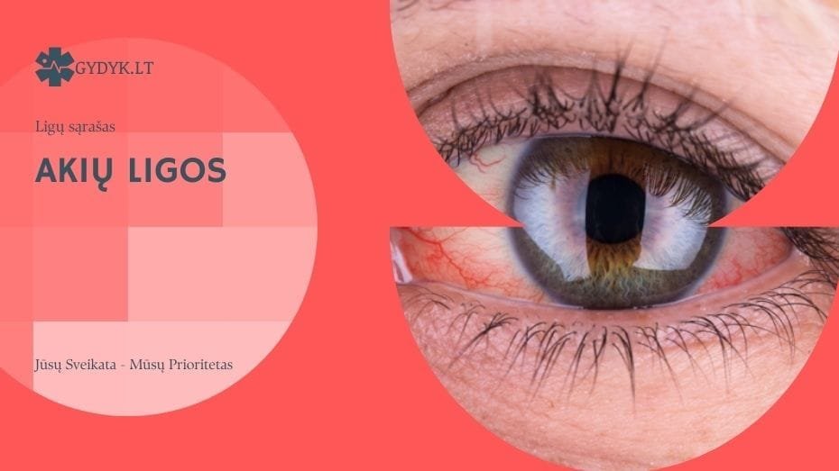 Akių Ligos: Išsamus Sąrašas, Simptomai ir Gydymas