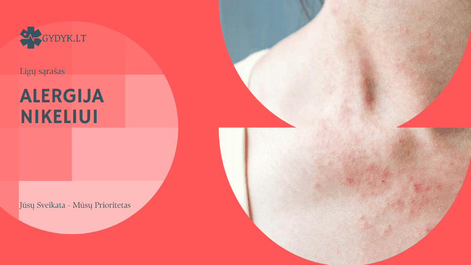 Alergija nikeliui: priežastys, simptomai ir gydymas