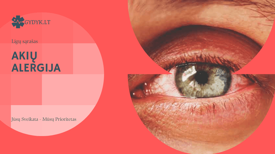 Akių alergija: priežastys, simptomai ir gydymas