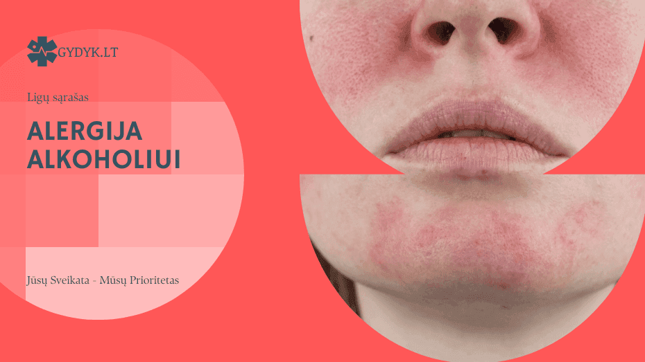 Alergija alkoholiui: priežastys, simptomai ir kaip ją valdyti