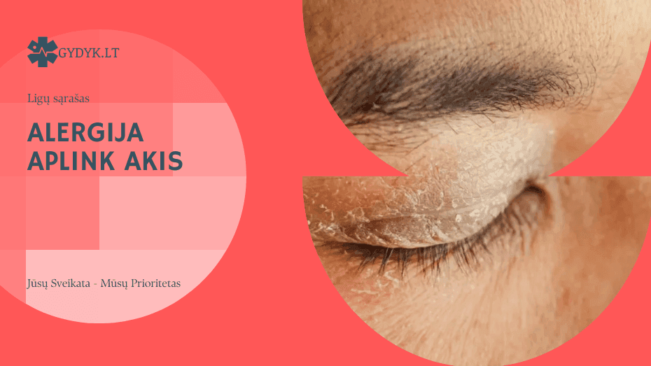 Alergija aplink akis: priežastys, simptomai ir gydymas