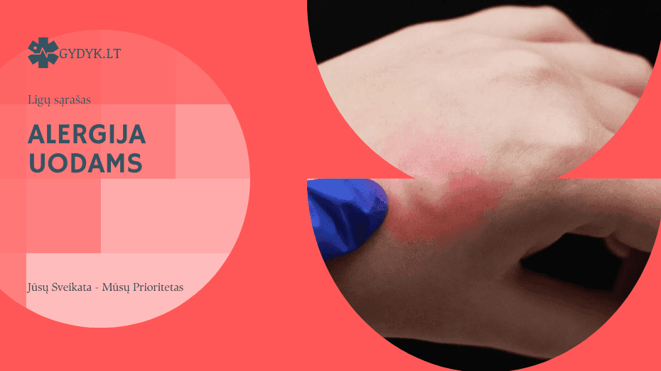 Alergija uodams: priežastys, simptomai ir kaip apsisaugoti