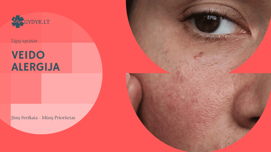 Veido alergija: priežastys, simptomai ir gydymas