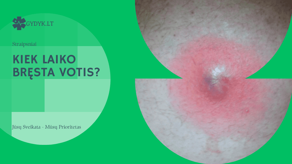 Kiek laiko bręsta votis