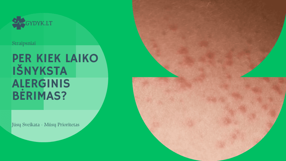 Per kiek laiko išnyksta alerginis bėrimas