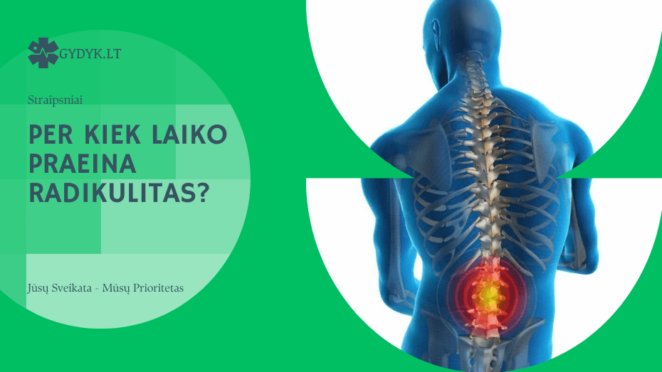 Per kiek laiko praeina radikulitas