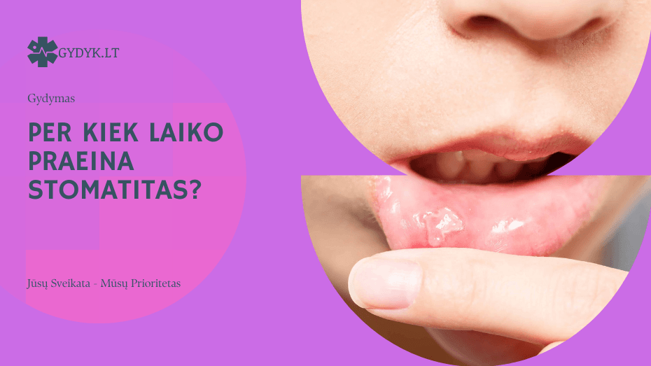 Per kiek laiko praeina stomatitas