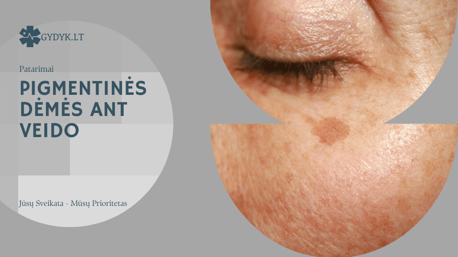 Pigmentinės dėmės ant veido: kaip jas naikinti ir užkirsti kelią atsiradimui Pigmentinės dėmės ant veido
