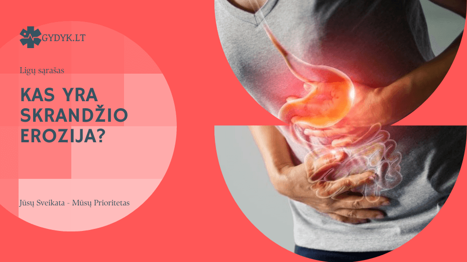 kas yra skrandžio erozija