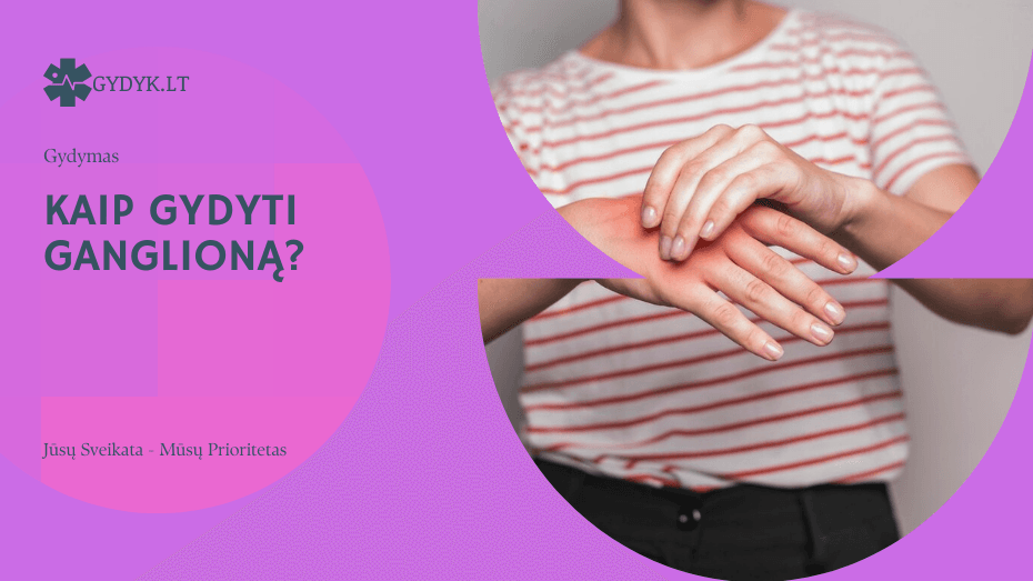 Kaip gydyti ganglioną? Kaip gydyti ganglioną