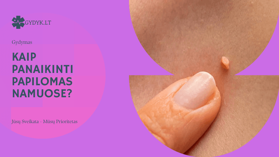 Kaip panaikinti papilomas namuose: gydytojų patarimai Kaip panaikinti papilomas namuose