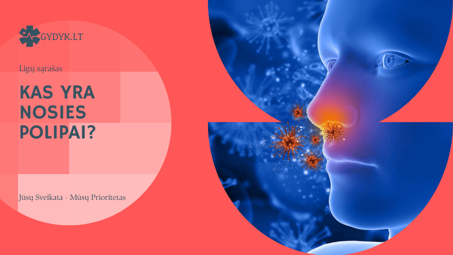 Kas yra nosies polipai