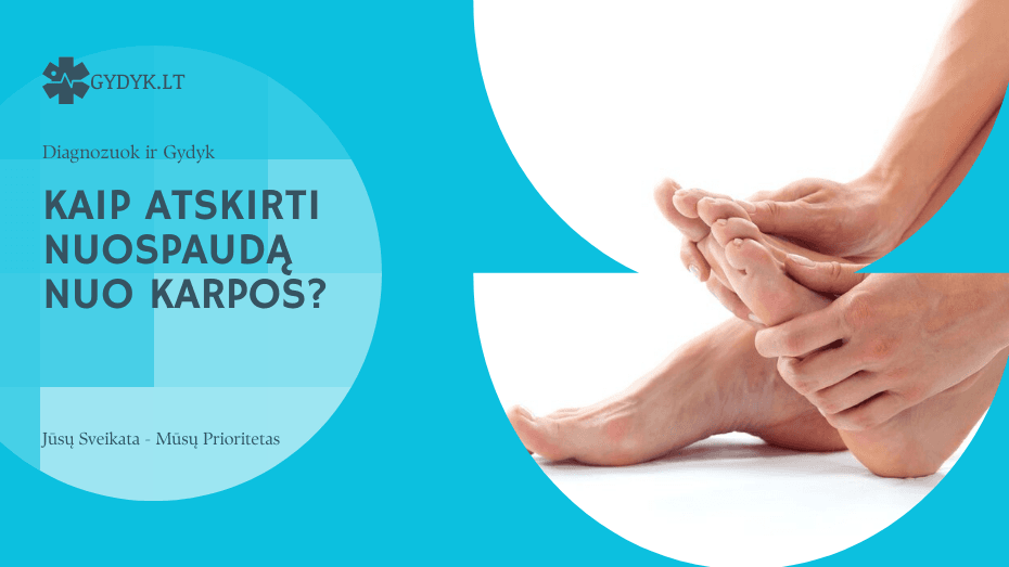 kaip atskirti nuospaudą nuo karpos