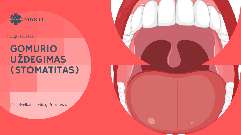 Gomurio uždegimas (Stomatitas)