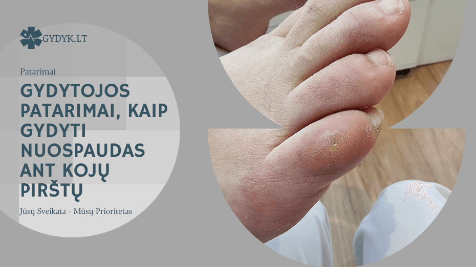 Gydytojos patarimai, kaip gydyti nuospaudas ant kojų pirštų