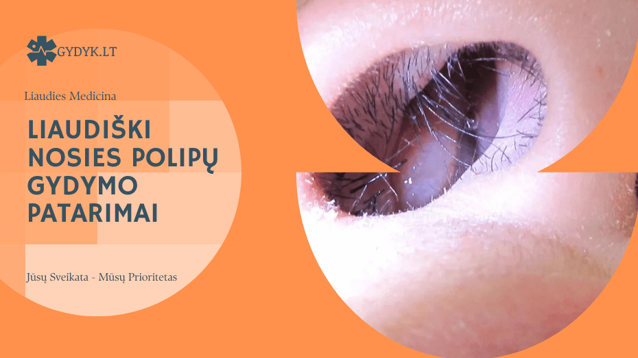 Liaudiški nosies polipų gydymo patarimai