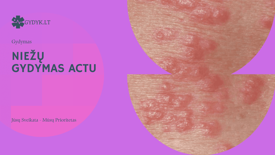 Niežų gydymas actu: kaip teisingai tai atlikti ir kiek tai veiksminga? Niežų gydymas actu