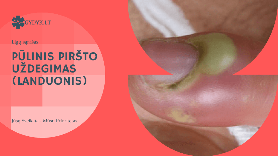 Pūlinis piršto uždegimas (landuonis)