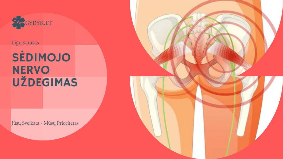 Sėdimojo nervo uždegimas