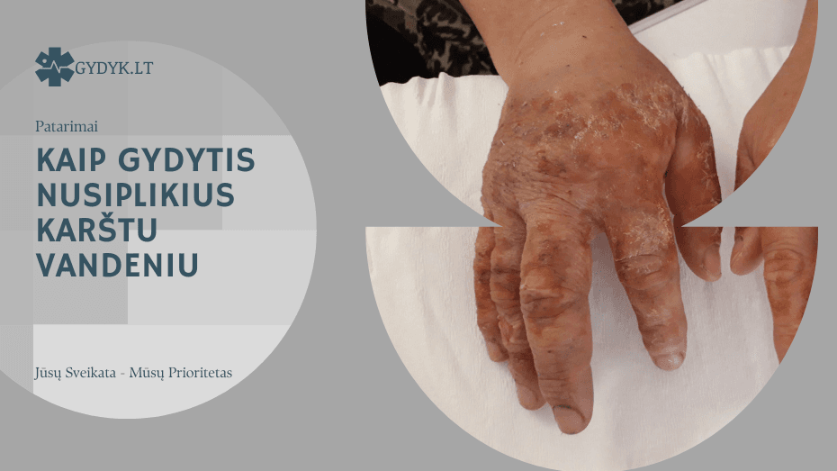 kaip gydytis nusiplikius karštu vandeniu