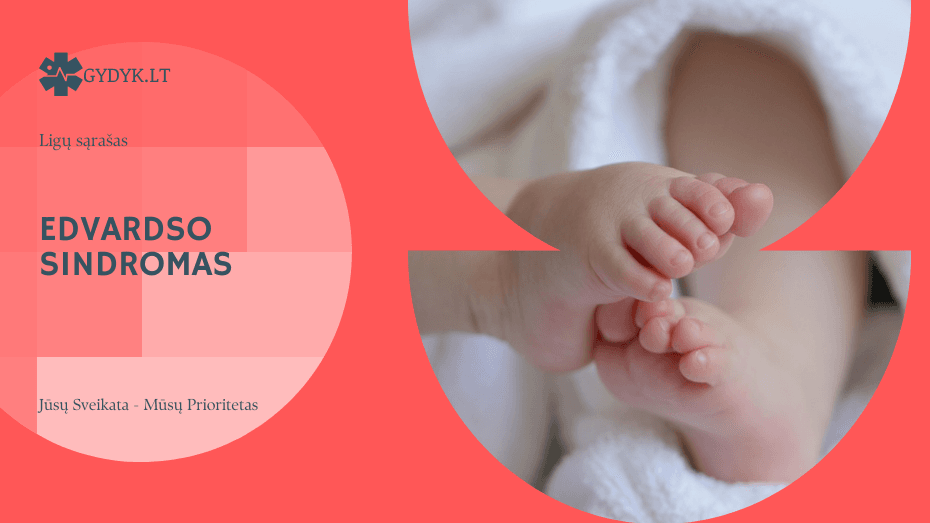 Edvardso sindromas