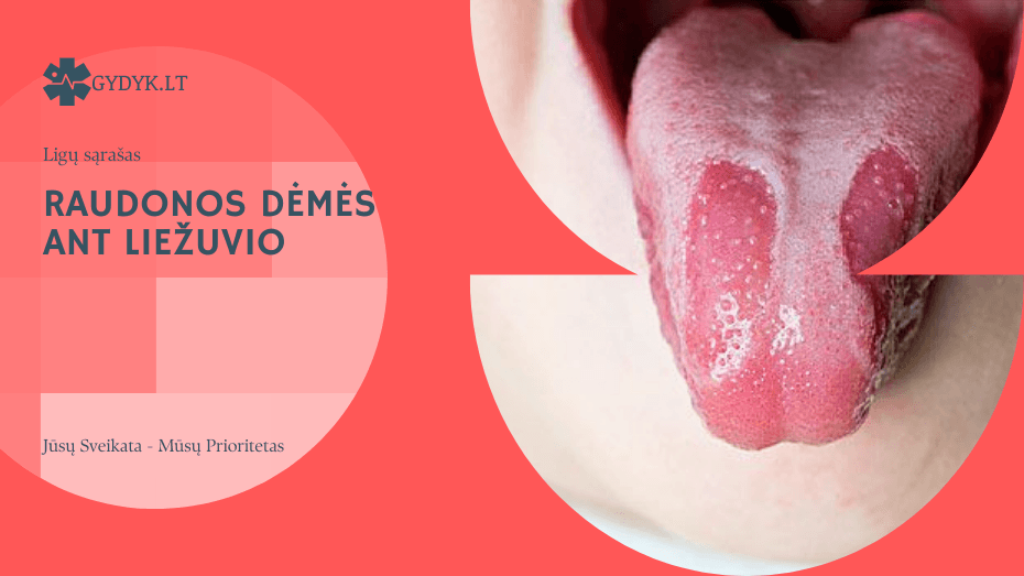 Raudonos dėmės ant liežuvio – infekcija, alergija ar kita liga? Raudonos dėmės ant liežuvio