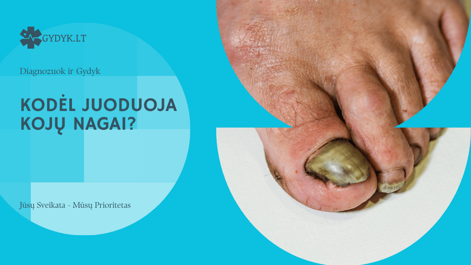 Juoduoja kojų nagai: kodėl ir ką daryti? kodėl Juoduoja kojų nagai