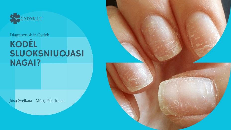 Sluoksniuojasi nagai: kodėl ir ką daryti? kodėl Sluoksniuojasi nagai?