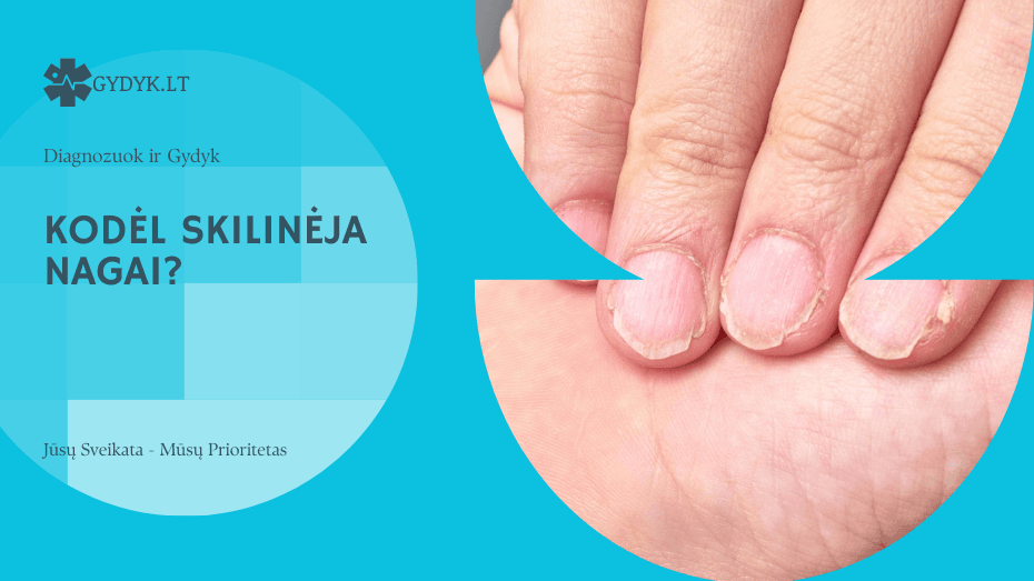 Skilinėja nagai: kodėl, kaip gydyti ir daktarų įžvalgos kodėl skilinėja nagai