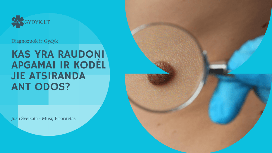 Kas yra raudoni apgamai ir kodėl jie atsiranda ant odos