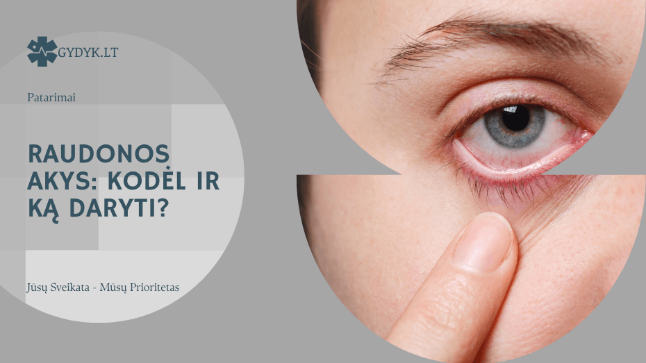 Raudonos akys kodėl ir ką daryti