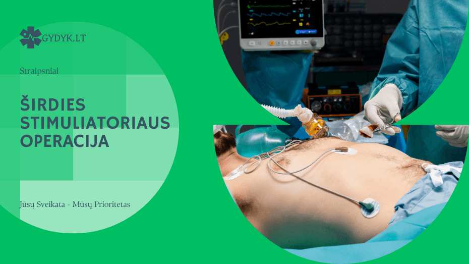 Širdies stimuliatoriaus operacija: kaip vyksta ir kiek trunka procedūra Širdies stimuliatoriaus operacija