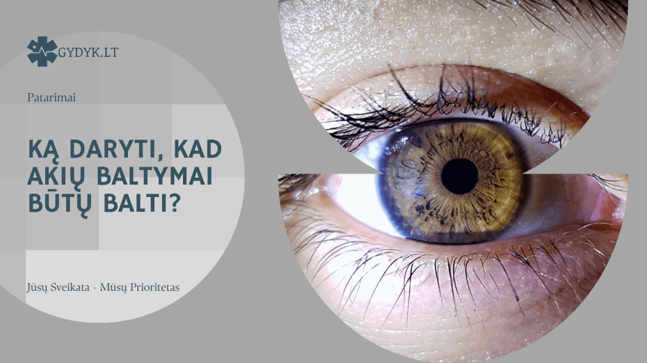 Ką daryti, kad akių baltymai būtų balti?