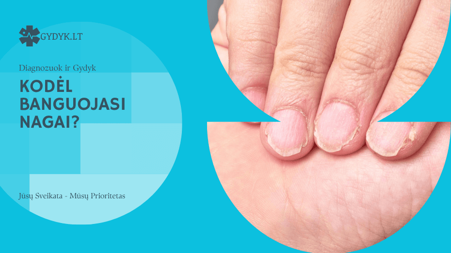 kodėl banguojasi nagai