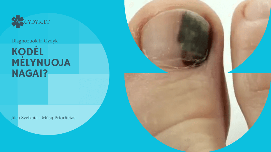 kodėl mėlynuoja nagai