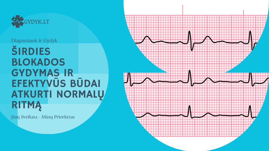 Širdies blokados gydymas ir efektyvūs būdai atkurti normalų ritmą
