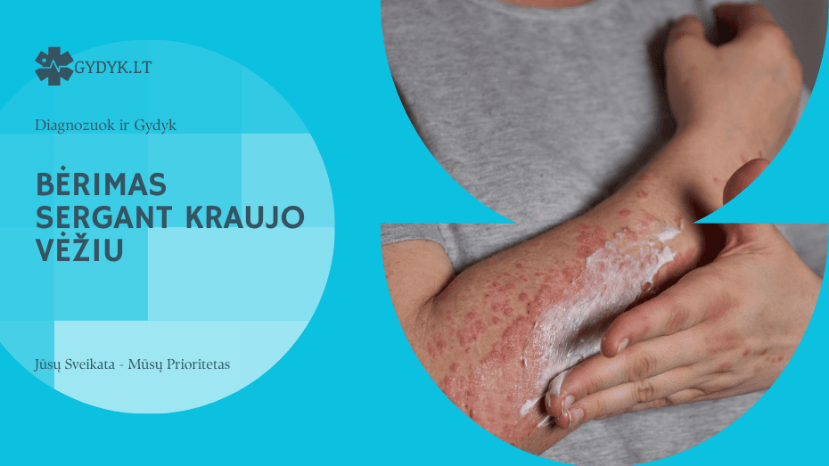 Bėrimas sergant kraujo vėžiu (leukemija): kaip jį atpažinti? Bėrimas sergant kraujo vėžiu