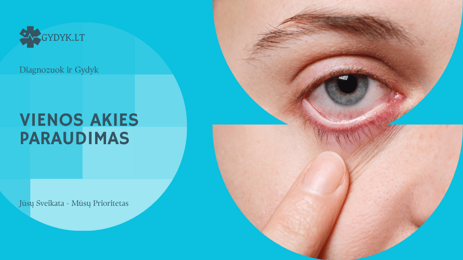 Vienos akies paraudimas: dažniausios priežastys ir gydymo būdai