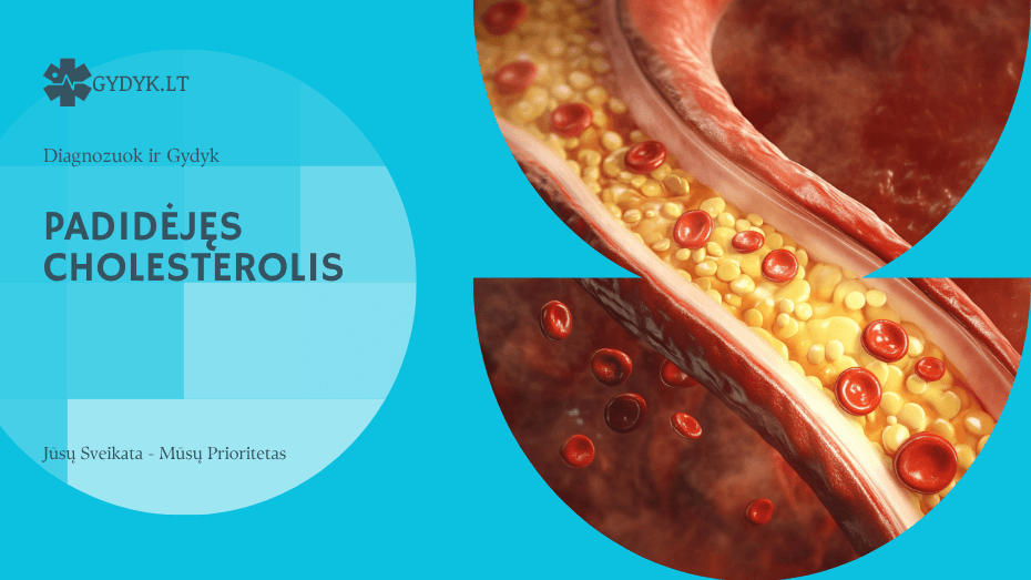 Padidėjęs cholesterolis – simptomai, priežastys ir pasekmės padidėjęs cholesterolis