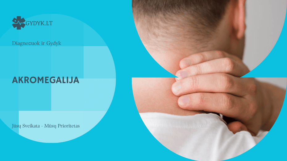 Akromegalija: simptomai, kas tai, kaip pasireiškia ir kaip gydoma