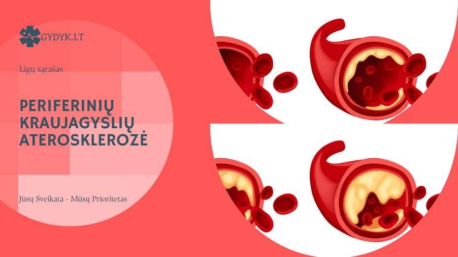 Periferinių kraujagyslių aterosklerozė: simptomai ir gydymo ypatumai