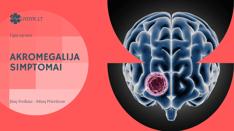 Akromegalija simptomai: kas tai, kaip pasireiškia ir kaip gydoma