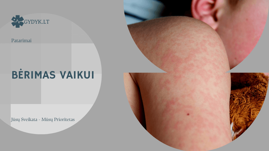 Bėrimas vaikui: dažniausios infekcinės ir alerginės priežastys