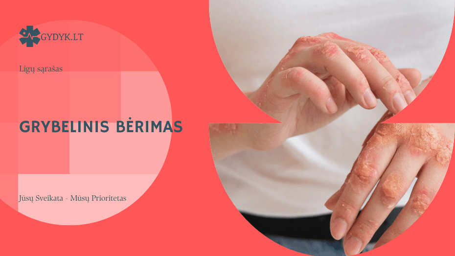 Grybelinis bėrimas: kaip atrodo ir kokie gydymo būdai veiksmingiausi