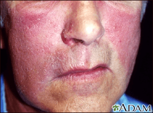 Rožės ligos (ant veido, kojos) nuotraukos: kaip atpažinti šią ligą?