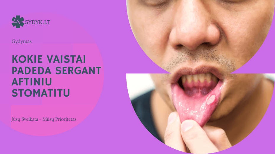 Kokie vaistai padeda sergant aftiniu stomatitu: gydymo pasirinkimai