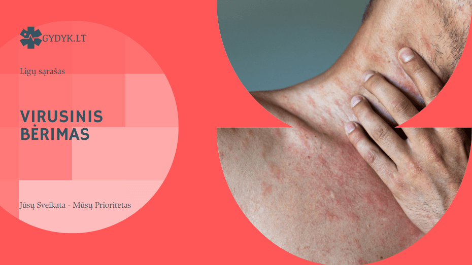 virusinis bėrimas