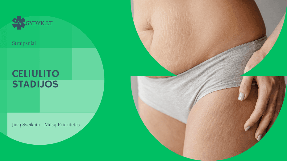 Celiulito stadijos