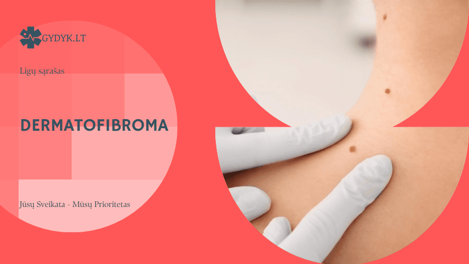Dermatofibroma: kas tai, kaip atrodo, ar pavojinga ir kada šalinti?